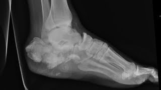 How to manage swelling amp pain post calcaneous fracture in young men of 20s Dr Mohan M R [upl. by Nolan19]