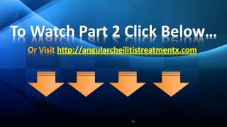 Angular Cheilitis Treatment  Angular Cheilitis Home Remedies [upl. by Nataniel]