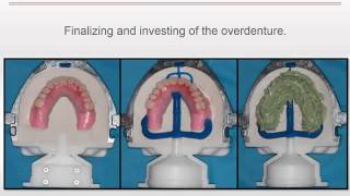 Clinical Case LOCATOR RTx by Nadim Baba DDS [upl. by Georgine]