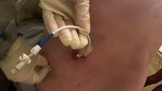 How to clean the area of nephrostomy or nephroureteral drain by Kathy [upl. by Egamlat]