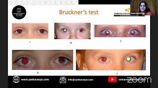 what test which age  pediatric optometric exam Learn from the Masters  Sankara Academy of Vision [upl. by Eihcir455]