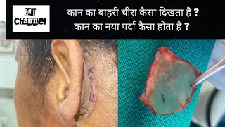 Outer incision for ear operation  How does new eardrum membrane looks like [upl. by Cloutman]