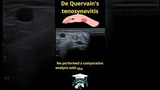 De Quervains Tenosynovitis Ultrasound Case Study ultrasoundstudent ultrasoundcases [upl. by Biernat]