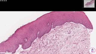 Mucous membrane pemphigoid [upl. by Hallee591]