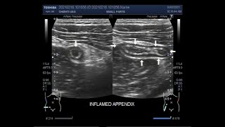 The scanning and localization of Acute Appendicitis [upl. by Fairlie]