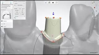 Dental Lab Life Designing an Abutment in 3Shape [upl. by Gertrudis]