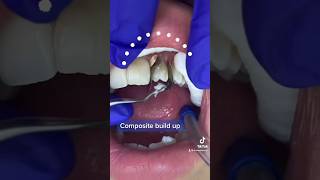 COMPOSITE BUILD Up tooth vlog [upl. by Dorree801]