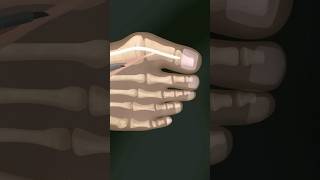 Minimal Invasive Bunion SurgeryVideo credit The Bunion Surgery Youtube [upl. by Sinned]