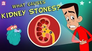 What Causes Kidney Stones  The Dr Binocs Show  Best Learning Videos For Kids  Peekaboo Kidz [upl. by Legna]