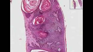 Histopathology Skin Seborrheic keratosis [upl. by Roti]