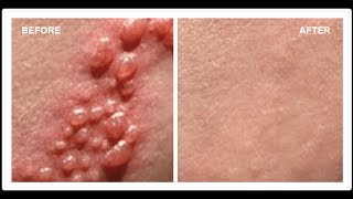 How To Cure Herpes  Cures for Herpes  Herpes Cures [upl. by Silisav]