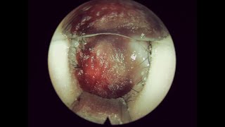 移除鼻填塞 Removal of Nasal Packing  PosiSep  004 [upl. by Tterrab]