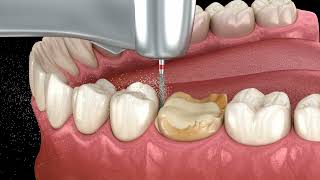 Caries removing process [upl. by Chadwick]