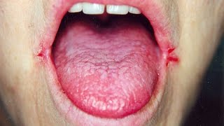 Angular Cheilitis ReviewHow To Treat Angular Cheilitis [upl. by Agathy679]