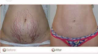 STRECH MARKS  pregnancy scarsPermanent Treatment for Strech Marks [upl. by Doyle]