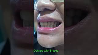 Denture With Braces How You Like That [upl. by Ajiak]