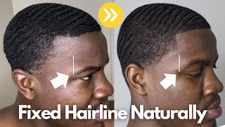 How I FIXED My Hairline Naturally  Receding Hairline [upl. by Aztinay]