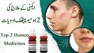 Top 2 Homeopathic Medicine for acne Acne treatment homeopathy  UrduHindi ایکنی کا ہومیوپیتھک علاج [upl. by Aizan123]