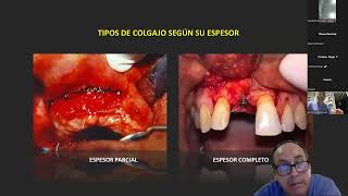 Extracciones dentales complejas [upl. by Ause]